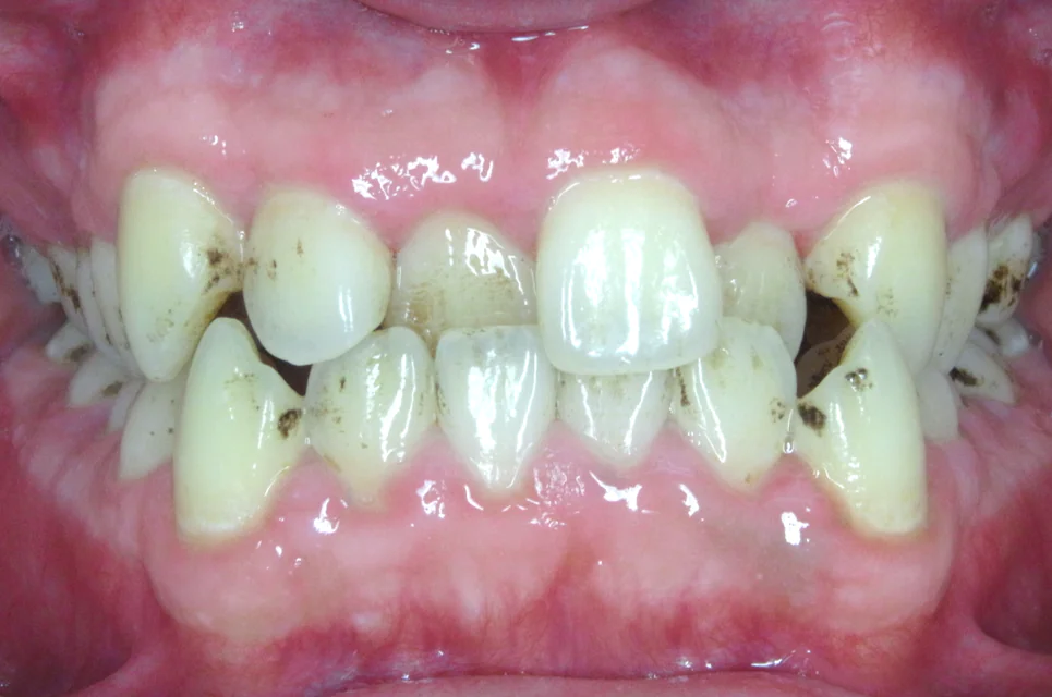ひまわり歯科矯正歯科 全顎矯正① before 正面