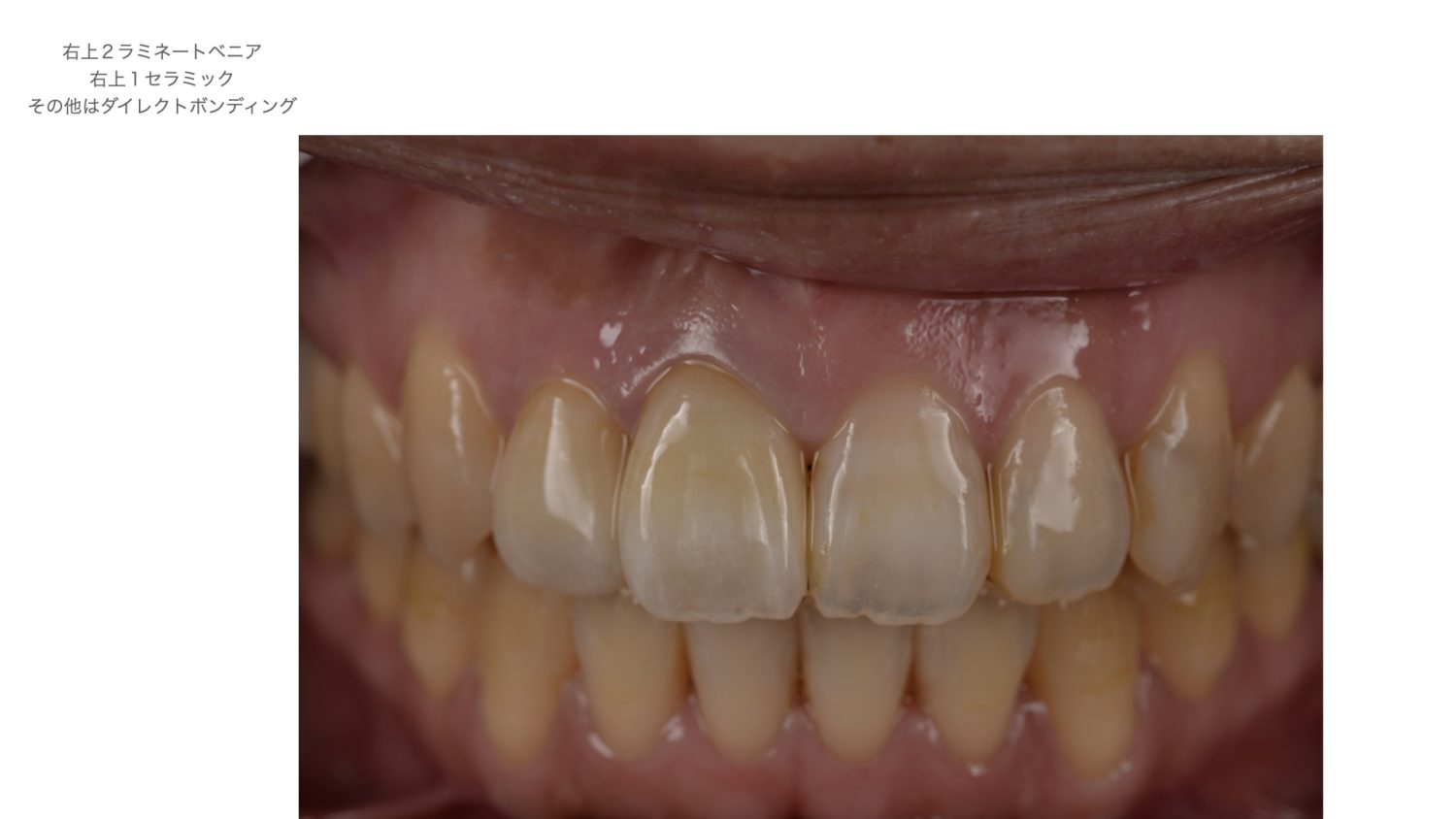 おぎの歯科医院 矯正治療・審美治療の症例紹介 after