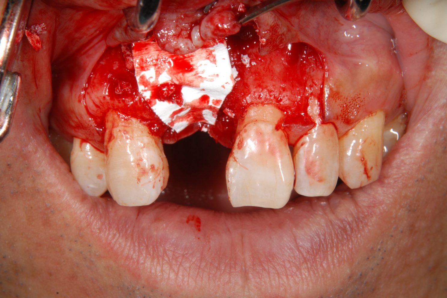 おぎの歯科医院 インプラント治療② 治療中