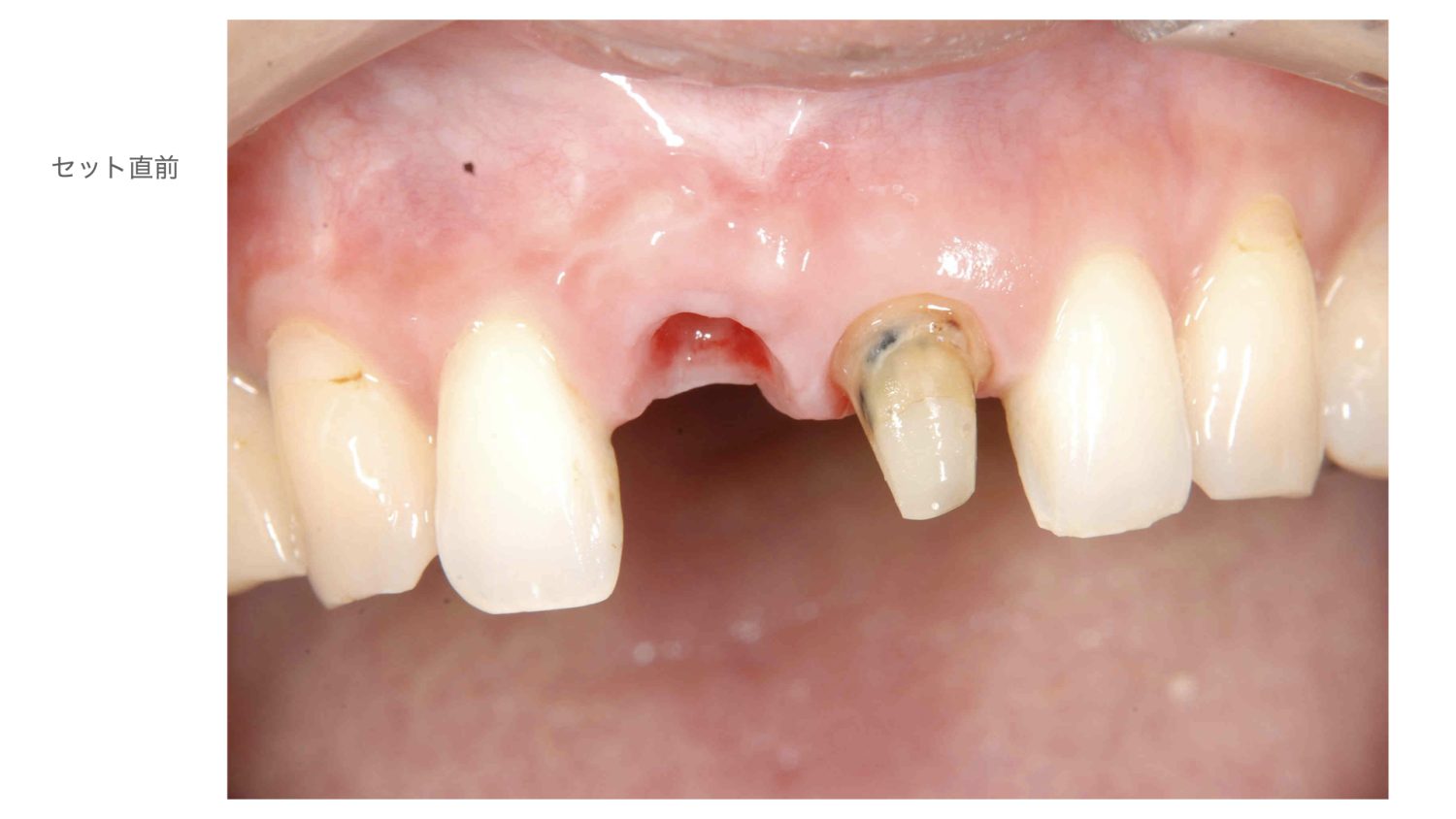 おぎの歯科医院 インプラント治療・セラミック治療③ before