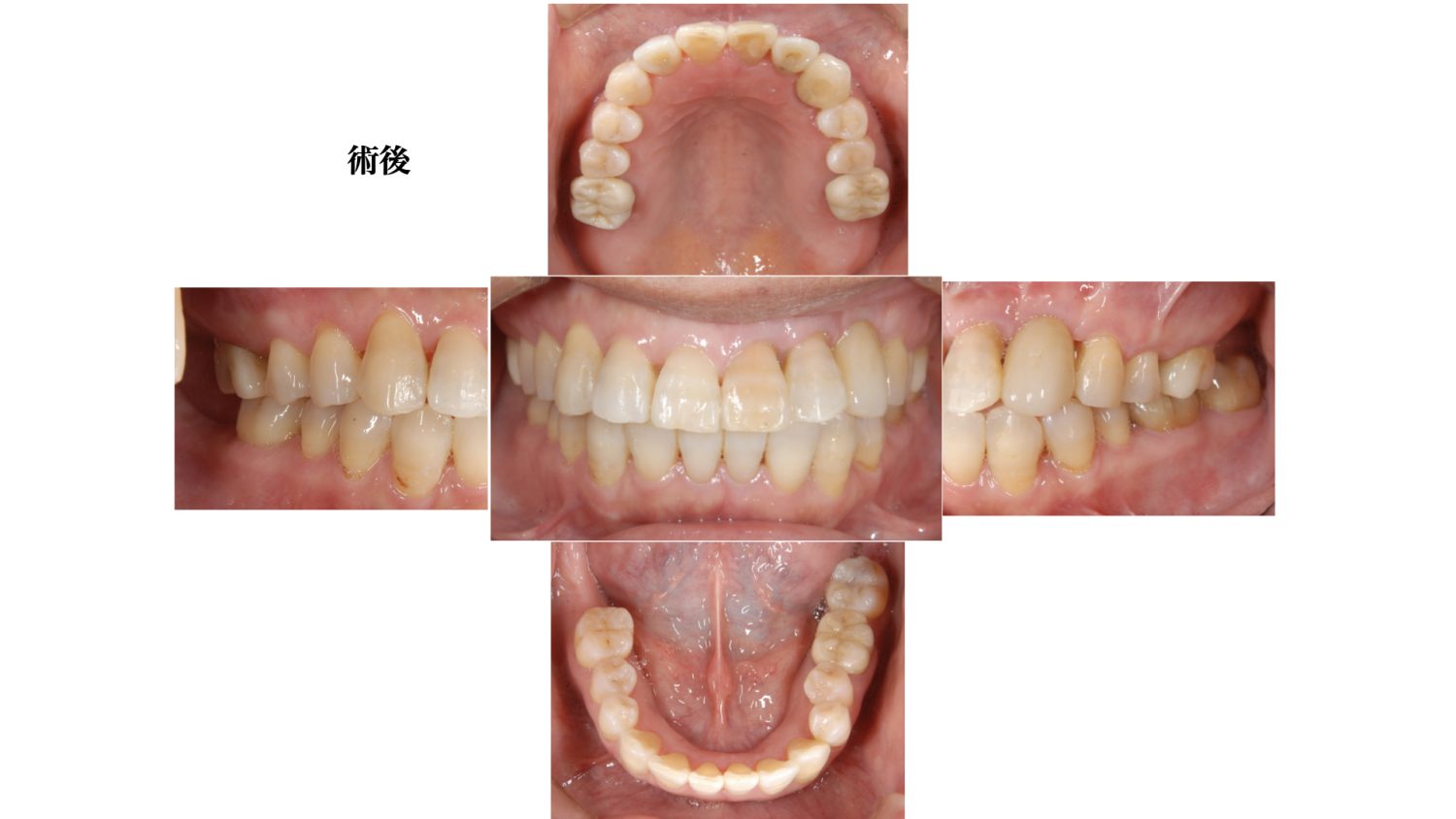 おぎの歯科医院 インプラント治療・矯正治療 after