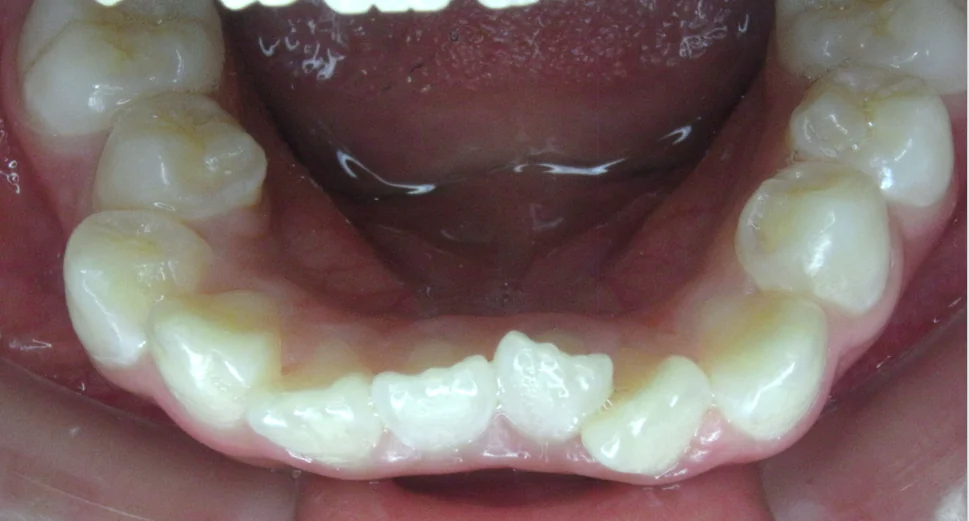 ひまわり歯科矯正歯科 全顎矯正③ before 下顎口腔内