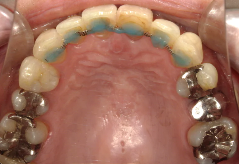 ひまわり歯科矯正歯科 部分矯正② after 上顎口腔内