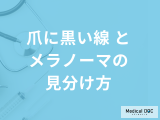 『爪に黒い線』が出たとき「メラノーマと別の疾患との見分け方」は？医師が解説！