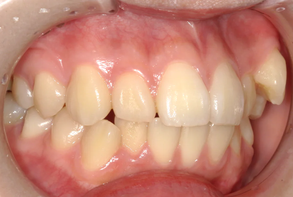 ひまわり歯科矯正歯科 部分矯正① before 右側面