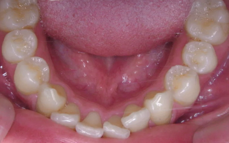 ひまわり歯科矯正歯科 全顎矯正⑤ before 下顎口腔内