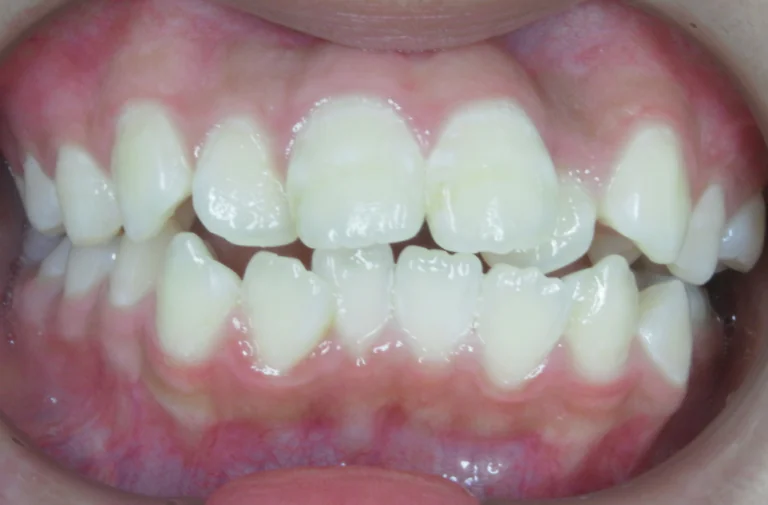 ひまわり歯科矯正歯科 全顎矯正③ before 正面