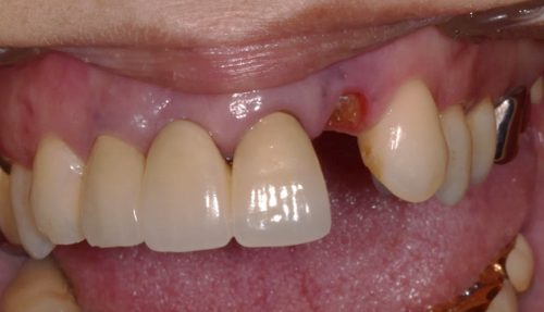 横浜日吉おおとう歯科-インプラント　GBR　歯肉移植-before-正面