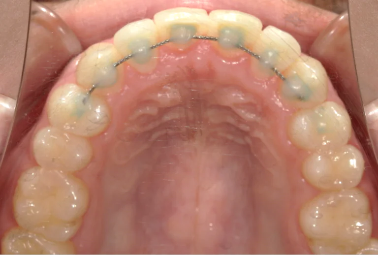 ひまわり歯科矯正歯科 部分矯正④ after 上顎口腔内