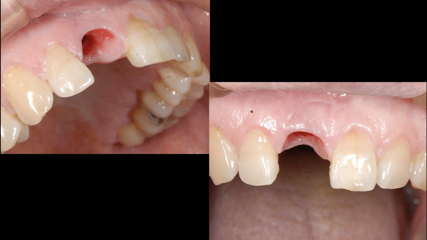 おぎの歯科医院 インプラント治療① 治療中
