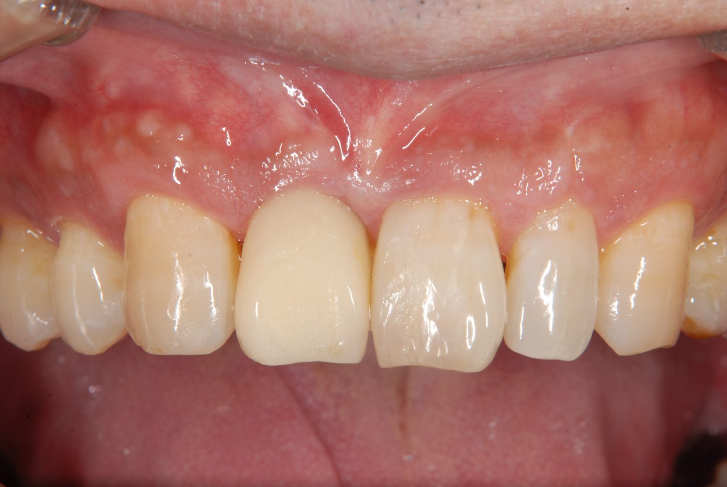 おぎの歯科医院 インプラント治療② after