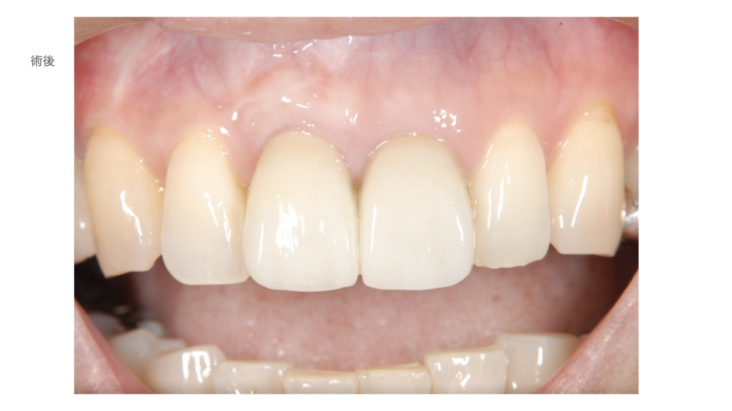 おぎの歯科医院 インプラント治療・セラミック治療③ after