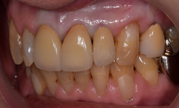 横浜日吉おおとう歯科-セラミッククラウン、ダイレクトボンディング、歯肉移植（結合組織移植）-after-正面