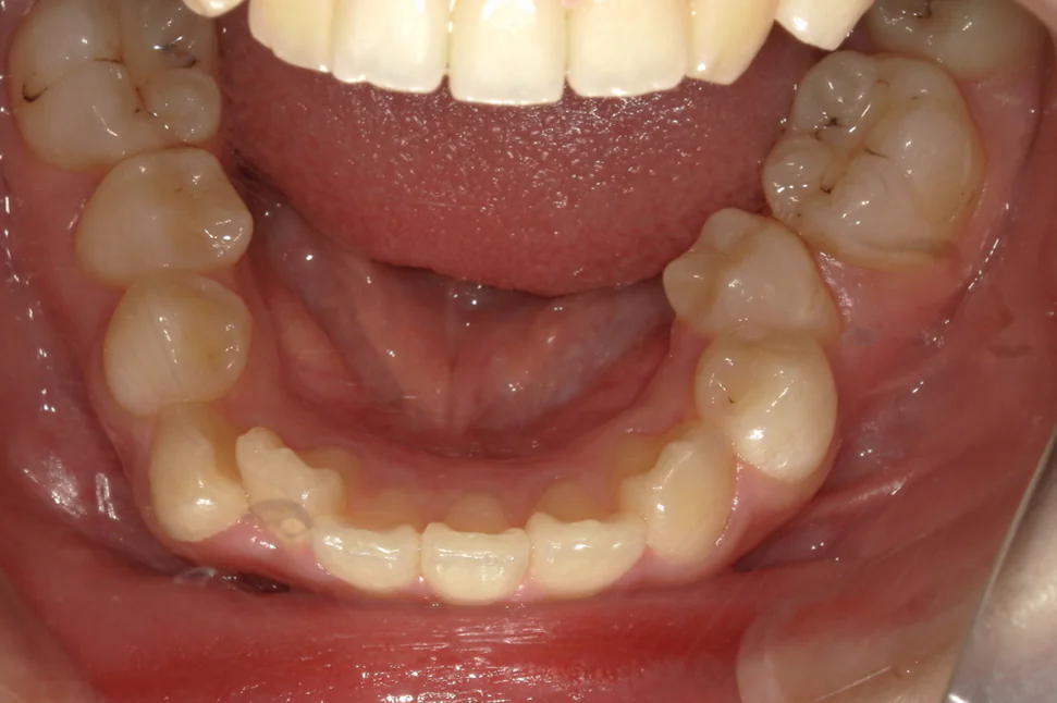 ひまわり歯科矯正歯科 部分矯正① before 下顎口腔内