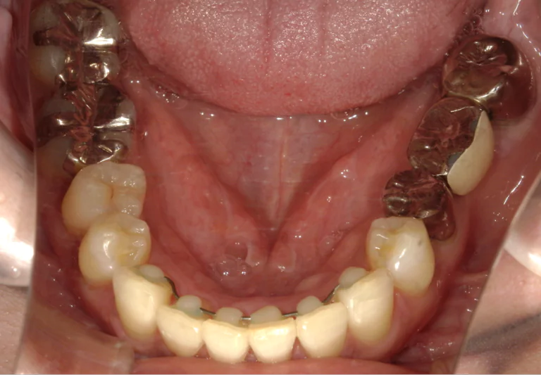 ひまわり歯科矯正歯科 部分矯正② after 下顎口腔内
