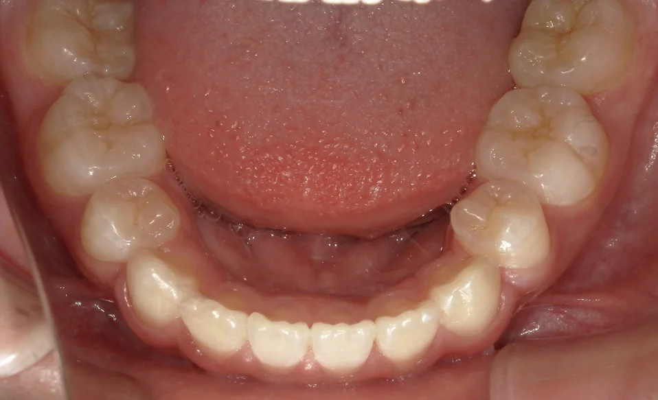 ひまわり歯科矯正歯科 全顎矯正③ after 下顎口腔内