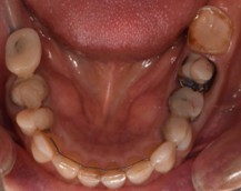 横浜日吉おおとう歯科-インプラント　セラミッククラウン②-before-下