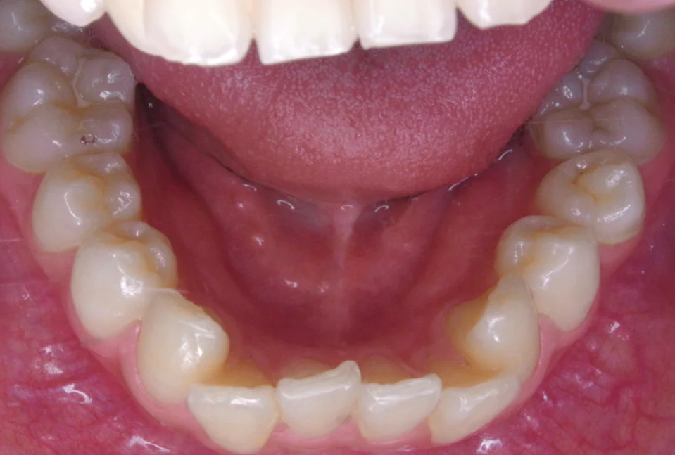 ひまわり歯科矯正歯科 全顎矯正② before 下顎口腔内