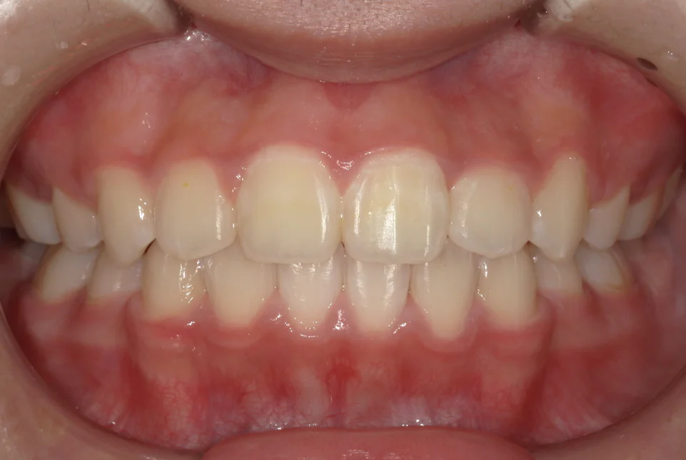 ひまわり歯科矯正歯科 全顎矯正③ after 正面