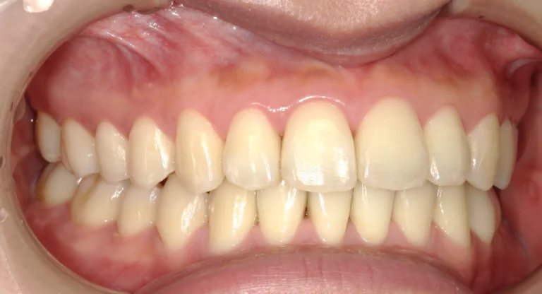 ひまわり歯科矯正歯科 全顎矯正⑤ after 右側面