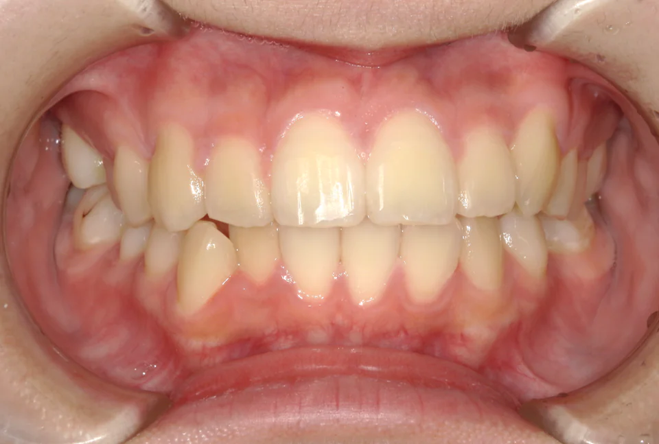 ひまわり歯科矯正歯科 部分矯正① after 正面