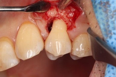 戸越なかやま歯科＋Er:YAGレーザーを併用した歯周組織再生療法＋手術中の症例