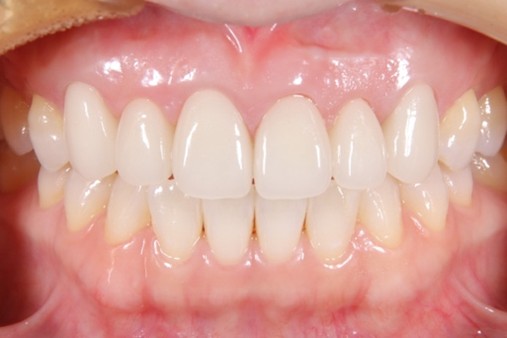 戸越なかやま歯科＋歯周病患者に対して前歯部に審美修復を行ったケース＋セラミック仮着時の症例