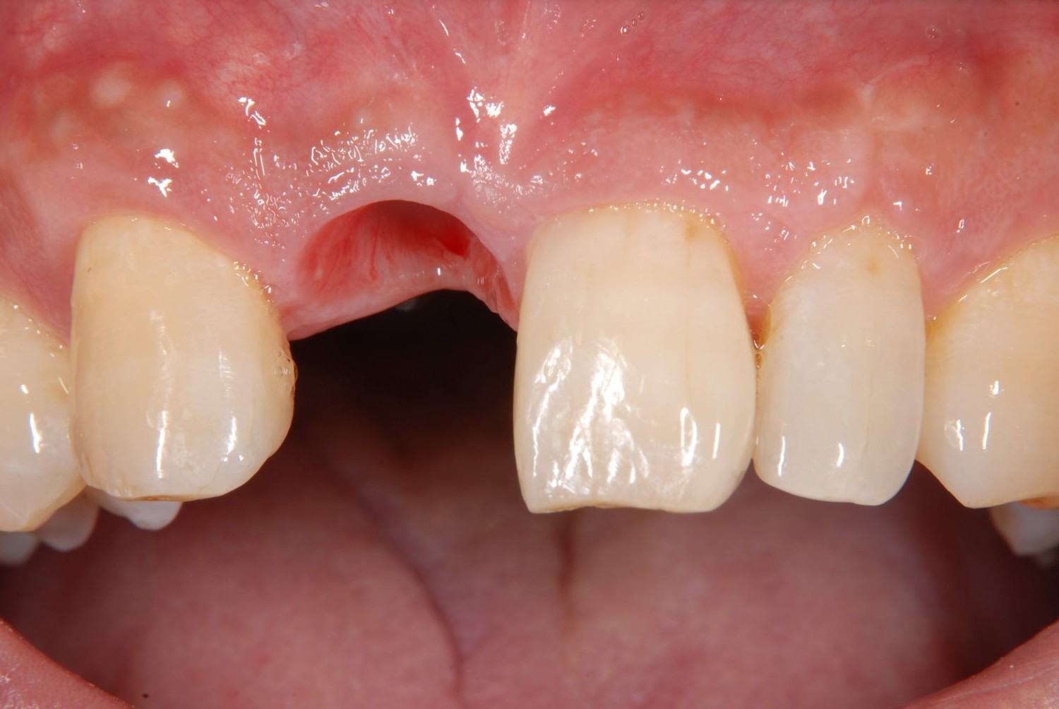 おぎの歯科医院 インプラント治療② 治療中