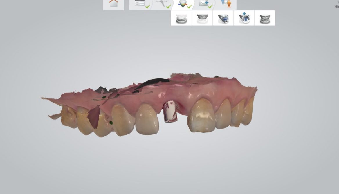 おぎの歯科医院 インプラント治療① 治療中