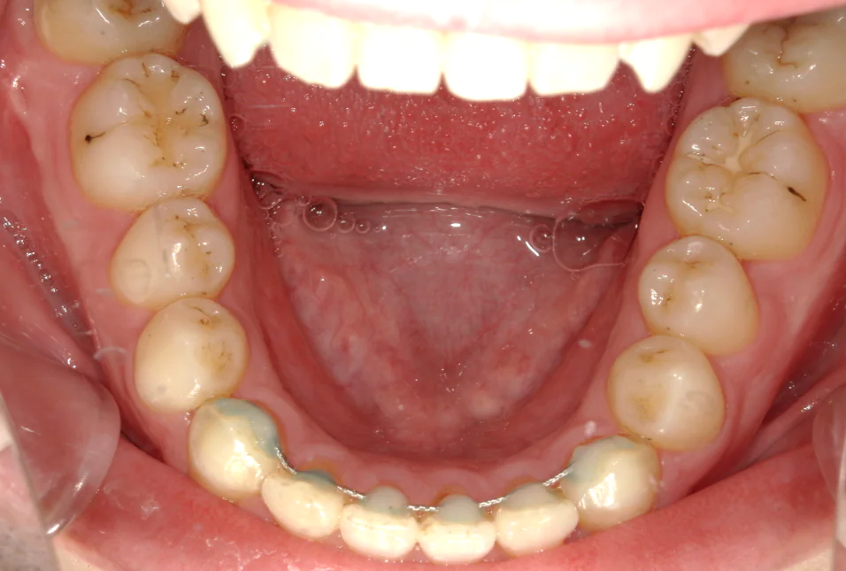 ひまわり歯科矯正歯科 全顎矯正① after 下顎口腔内