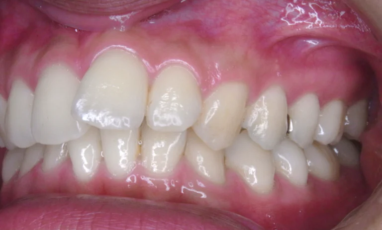 ひまわり歯科矯正歯科 全顎矯正⑤ before 左側面