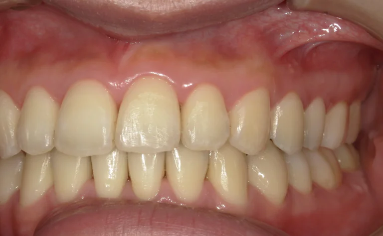 ひまわり歯科矯正歯科 全顎矯正⑤ after 左側面