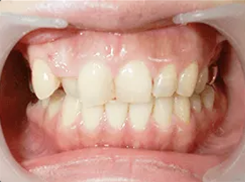 ロイヤル歯科クリニック代々木＋E-maxクラウン＋before