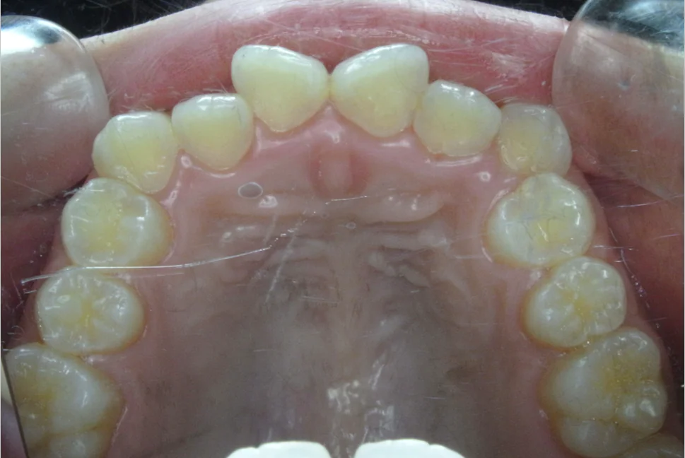 ひまわり歯科矯正歯科 部分矯正③ before 上顎口腔内