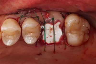 戸越なかやま歯科＋歯根破折した歯に対してRidge Preservationを行いインプラント埋入を行ったケースの症例＋インプラント埋入時