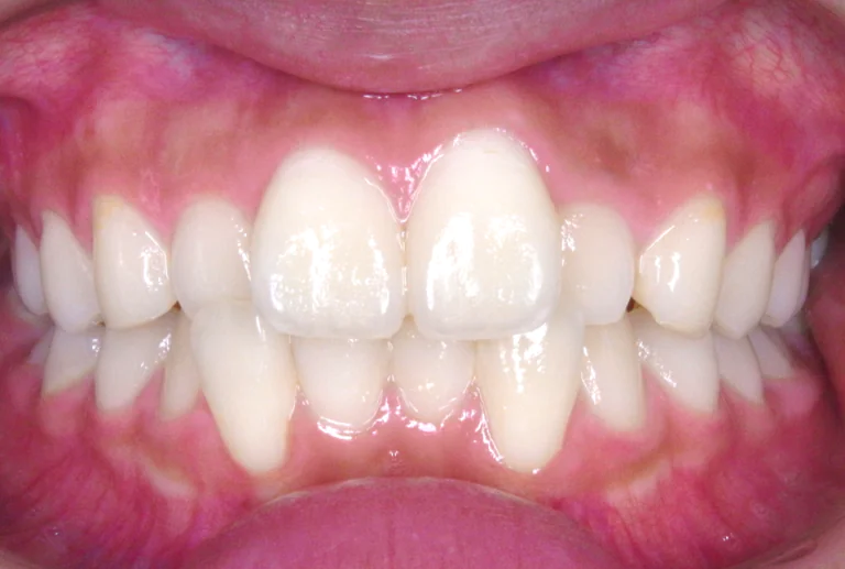 ひまわり歯科矯正歯科 全顎矯正② before 正面