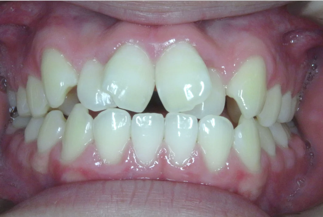 ひまわり歯科矯正歯科 部分矯正④ before 正面