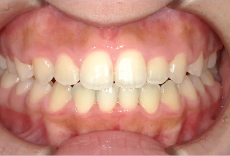 ひまわり歯科矯正歯科 部分矯正③ after 正面