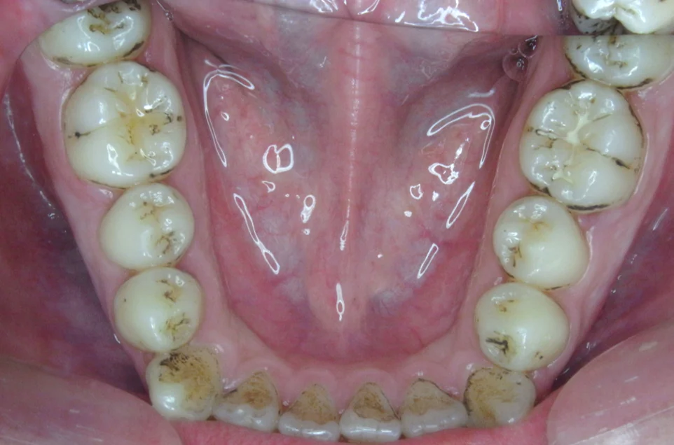 ひまわり歯科矯正歯科 全顎矯正① before 下顎口腔内