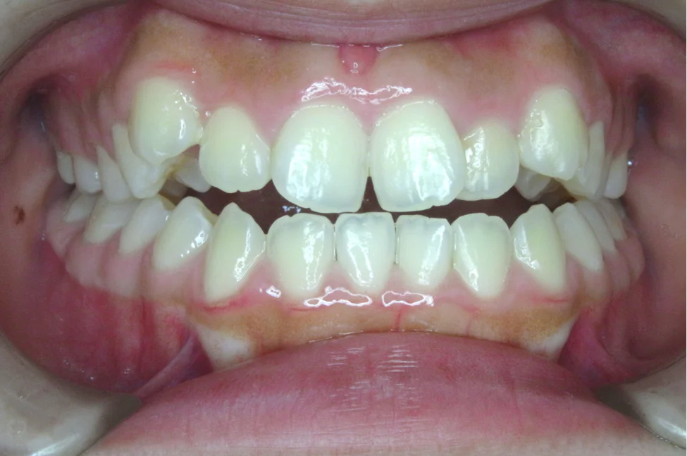 ひまわり歯科矯正歯科 部分矯正③ before 正面