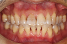 戸越なかやま歯科＋下顎前歯歯肉退縮に対する歯肉移植術＋before