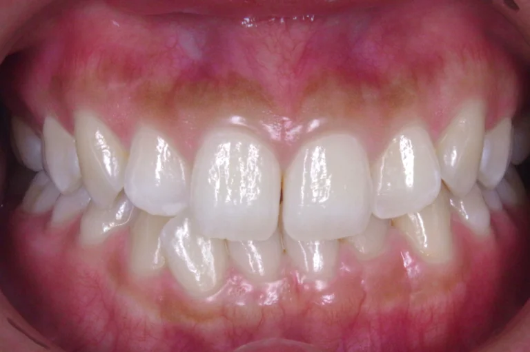 ひまわり歯科矯正歯科 全顎矯正④ before 正面