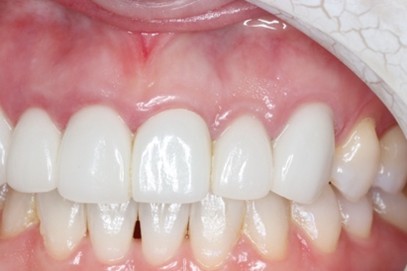 戸越なかやま歯科＋歯周病患者に対して前歯部に審美修復を行ったケース＋before