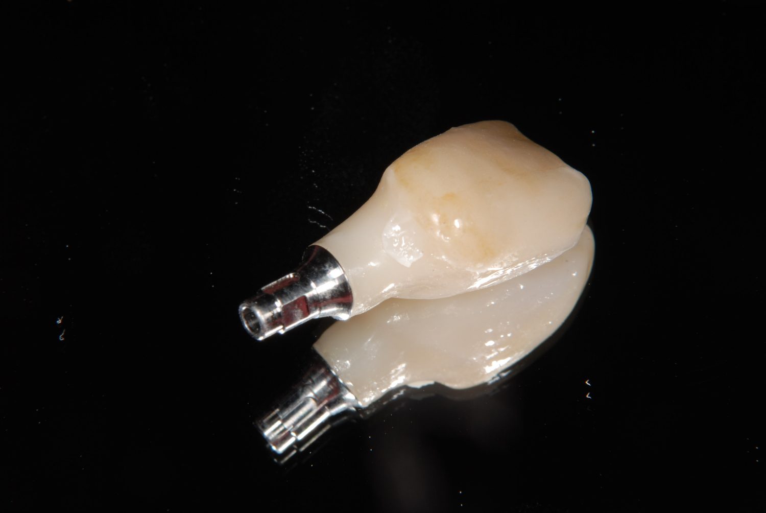おぎの歯科医院 インプラント治療② 治療中