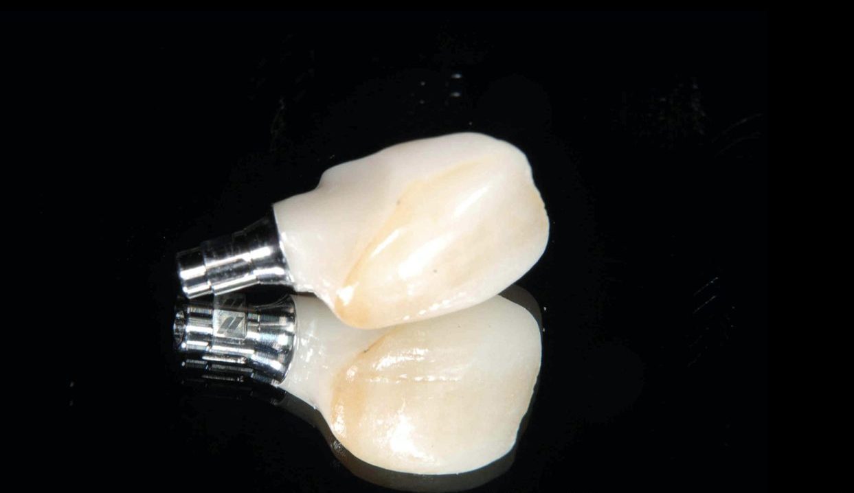 おぎの歯科医院 インプラント治療① 治療中