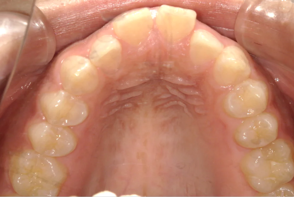 ひまわり歯科矯正歯科 部分矯正⑥ before 上顎口腔内