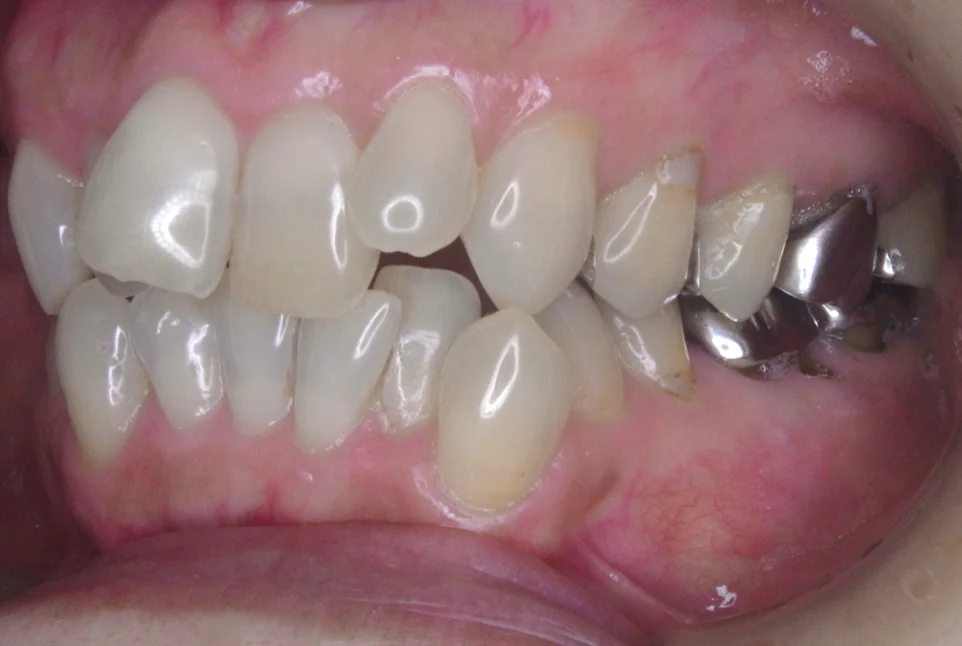 ひまわり歯科矯正歯科 部分矯正② before 左側面