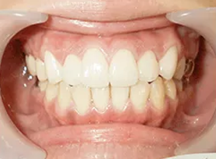 ロイヤル歯科クリニック代々木＋セラミック矯正＋after