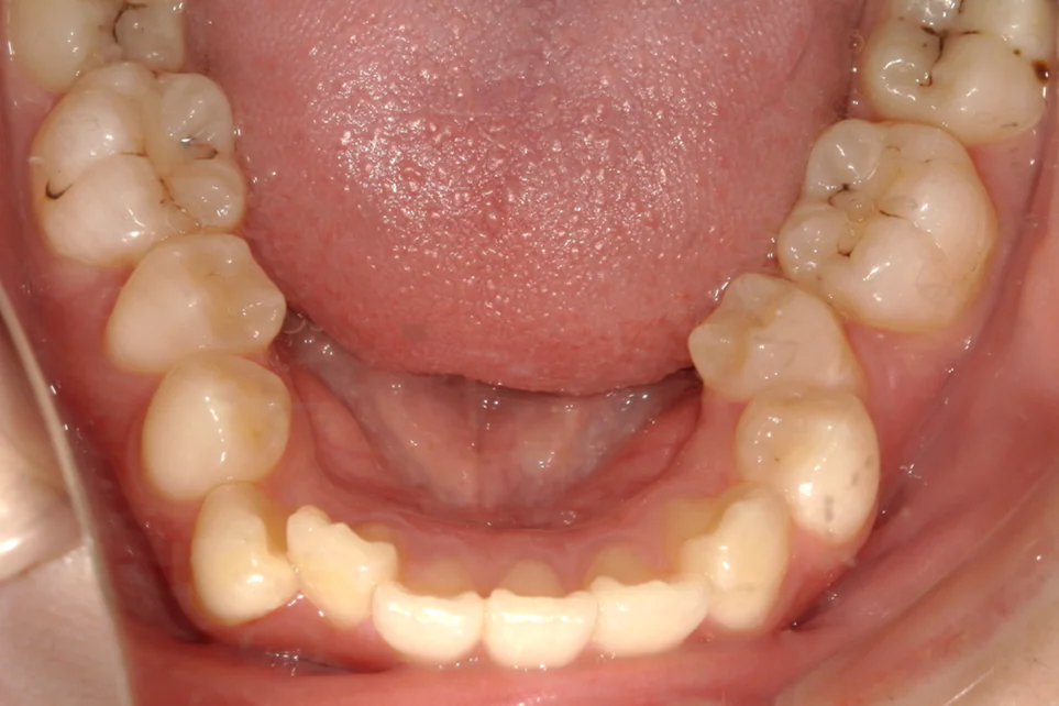 ひまわり歯科矯正歯科 部分矯正① after 下顎口腔内