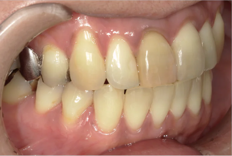 ひまわり歯科矯正歯科 部分矯正② after 右側面